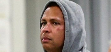 Did Alex Rodriguez have a black eye when he came back from the Bahamas?