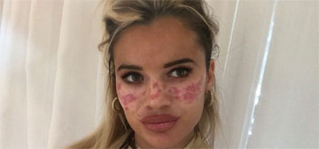 Australian Big Brother star has permanent scarring after trying TikTok freckle hack